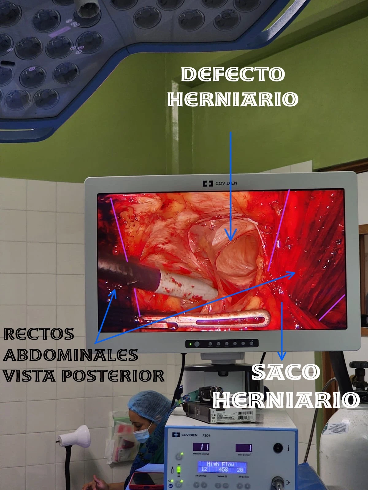Hernioplastia Laparoscopica